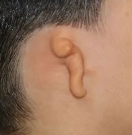 3rd Degree Microtia